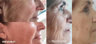 Neofound Profhilo Skin Boosters 