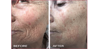 Profound - Before and after face comparison