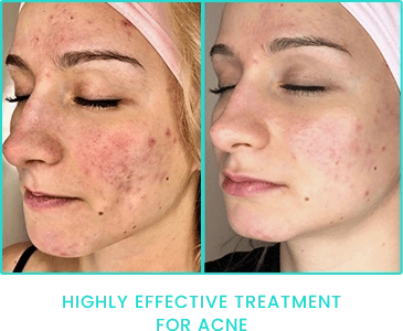 Peppermint Peel highly effective Acne treatment results Peppermint Peel highly effective Acne treatment results