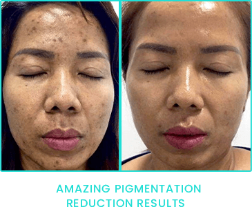 Peppermint Peel pigmentation reduction results Peppermint Peel pigmentation reduction results
