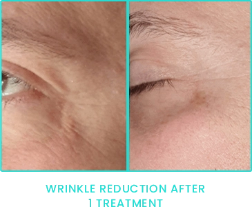 Peppermint Peel wrinkle reduction after one treatment Peppermint Peel wrinkle reduction after one treatment