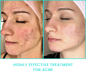Peppermint Peel highly effective Acne treatment results Peppermint Peel highly effective Acne treatment results