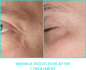 Peppermint Peel wrinkle reduction after one treatment Peppermint Peel wrinkle reduction after one treatment