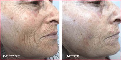 Profound - Before and after face comparison Profound - Before and after face comparison