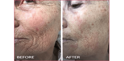 Profound - Before and after face comparison Profound - Before and after face comparison