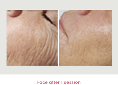 Profound - cheek wrinkles improvements after one session Profound - cheek wrinkles improvements after one session