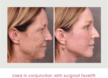 Profound - effect used in conjunction with a surgical facelift