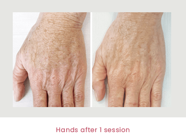 Profound - Hands after one session Profound - Hands after one session