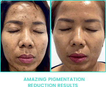 Peppermint Peel pigmentation reduction results