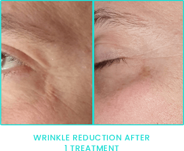 Peppermint Peel wrinkle reduction after one treatment