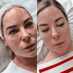 Hyperpigmentation treatment, Neofound Whitening