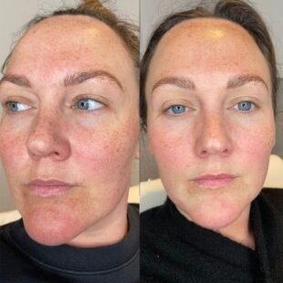 Neofound Whitening before and after