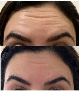 Yaqoot 24 hours later results showing reduction in dynamic wrinkles and improvements in laxity and hydration