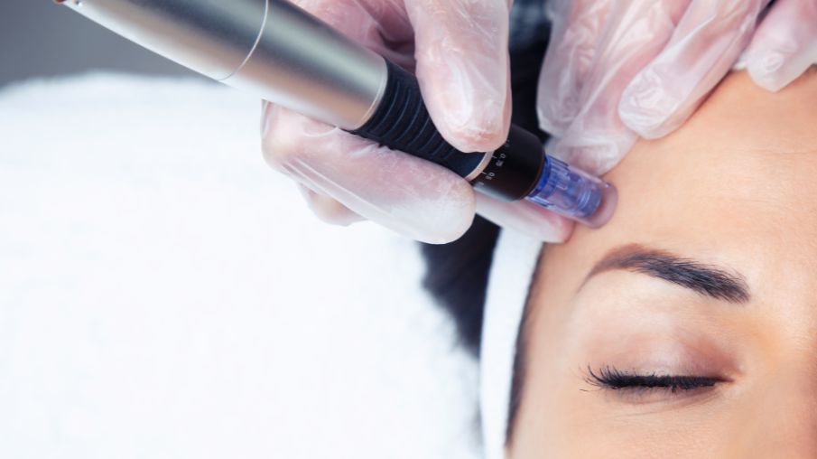 Microneedling Collagen Induction Therapy, What Clinicians Should Know